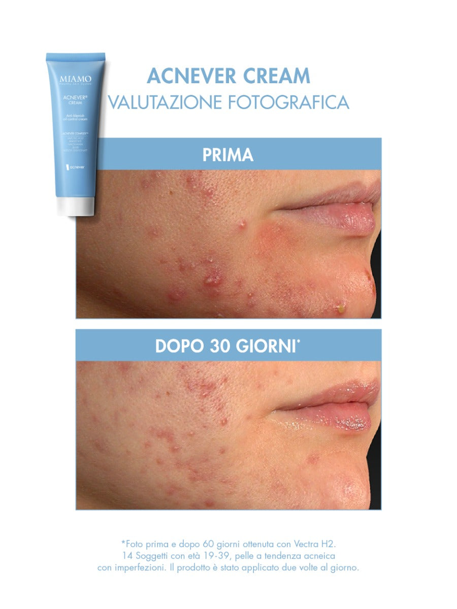 ACNEVER® CREAM anti imperfezioni